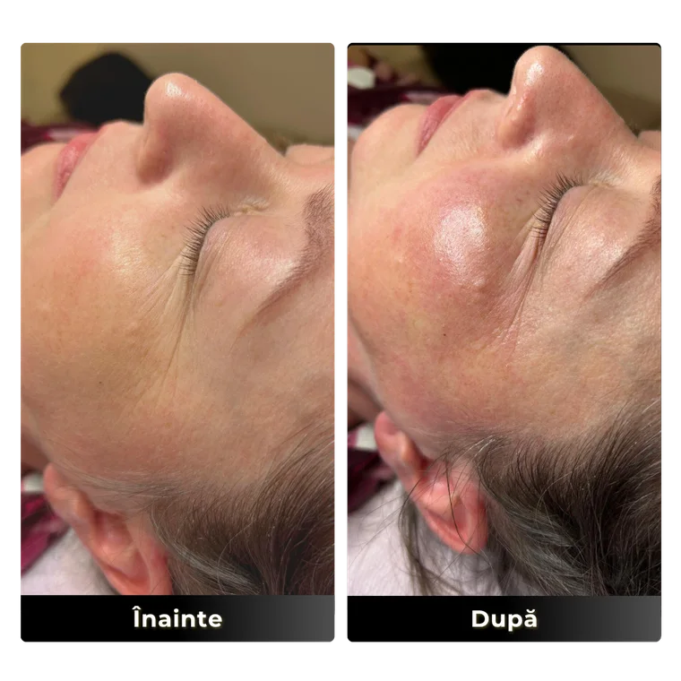 Rezultat real facial — hidratare și luminozitate