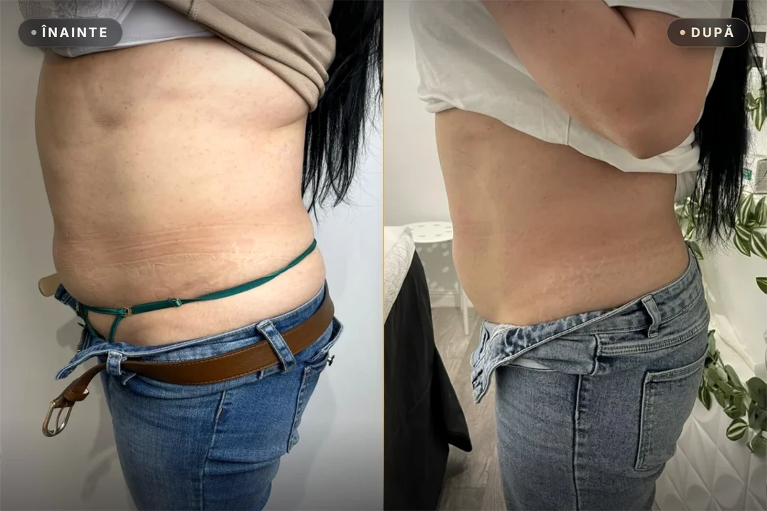 Rezultat real înainte și după — Liposonix abdomen