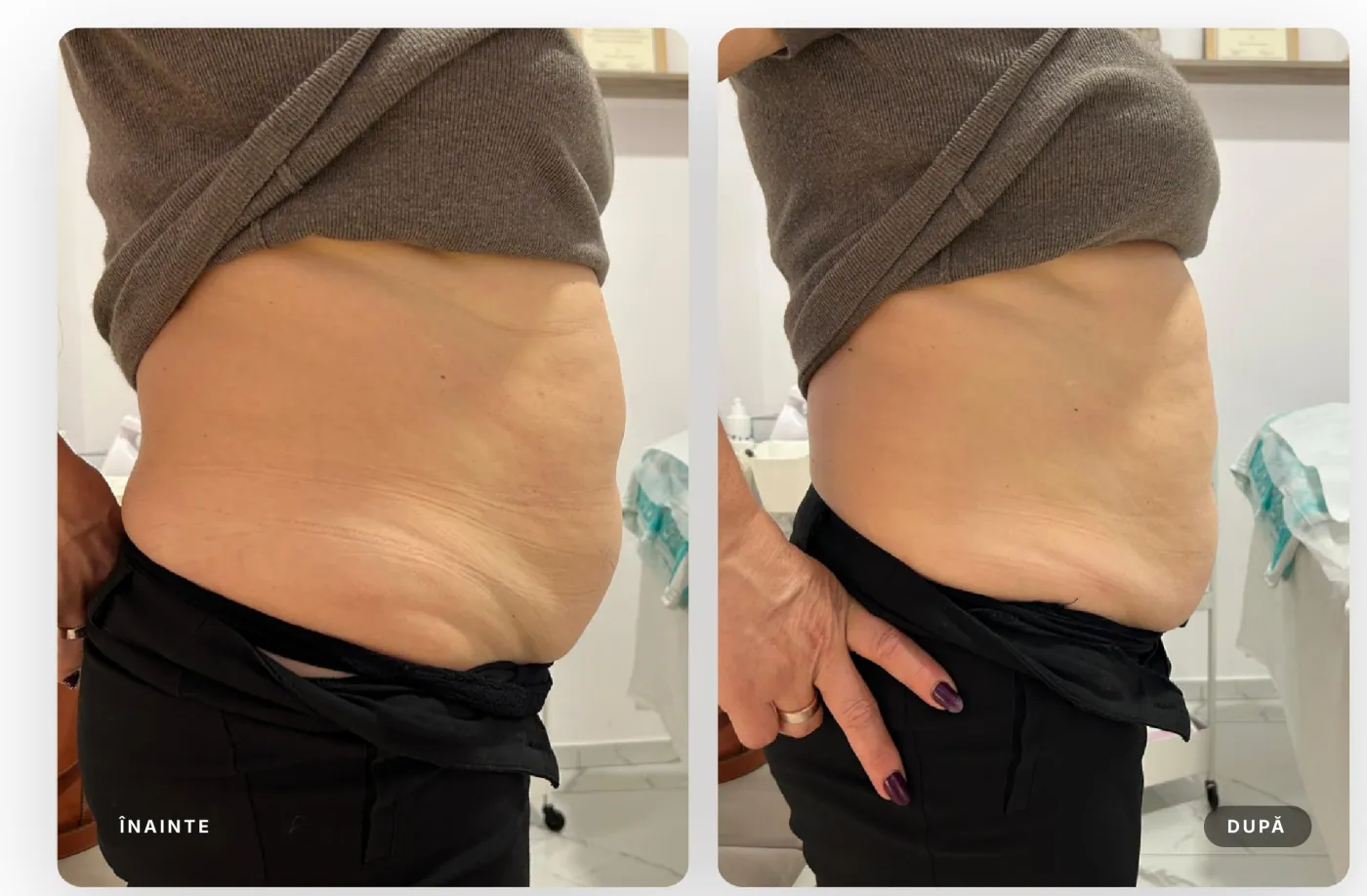 Rezultat real înainte și după, HIFU abdomen total