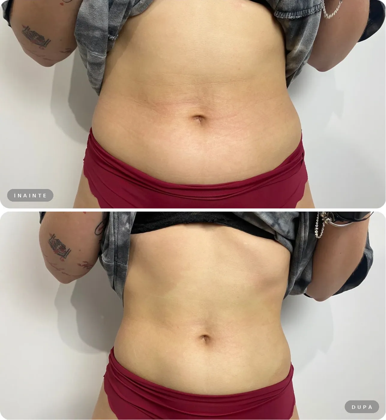 Rezultat real înainte și după, Liposonix abdomen