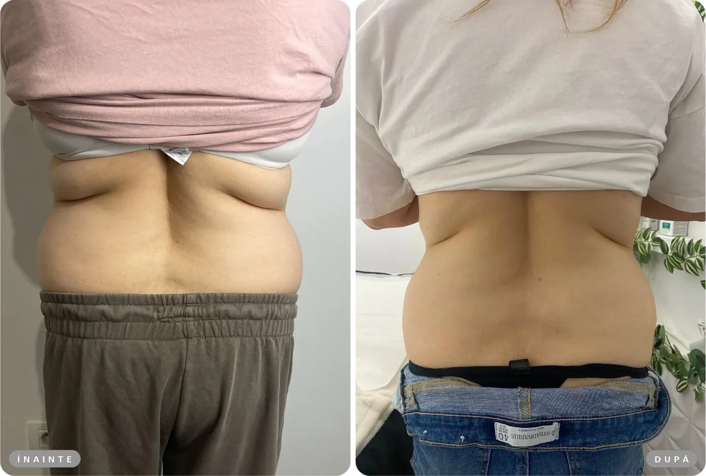 Rezultat real înainte și după, Liposonix șolduri
