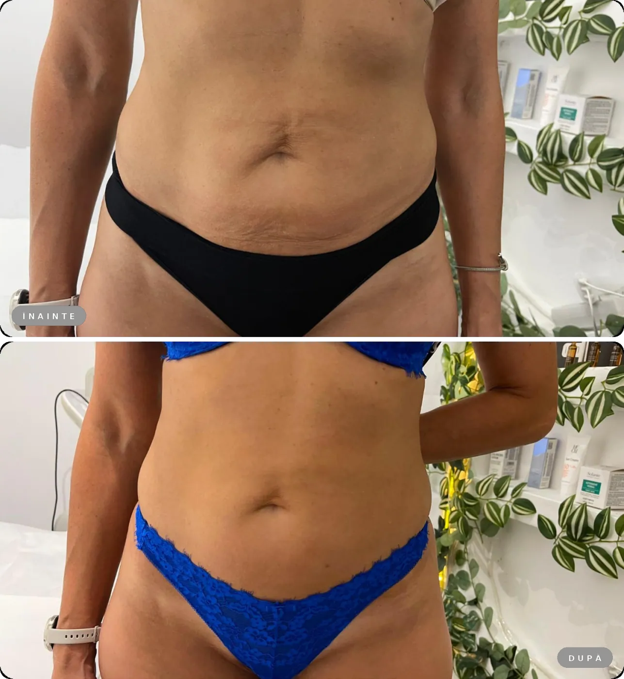 Rezultat real înainte și după, pachet Mini Belly