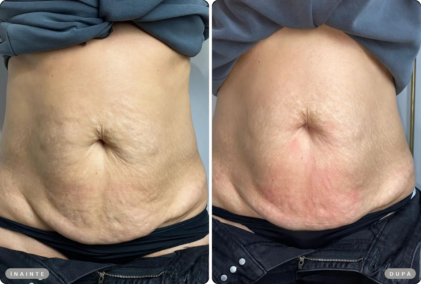Rezultat real înainte și după, HIFU laxitate abdomen
