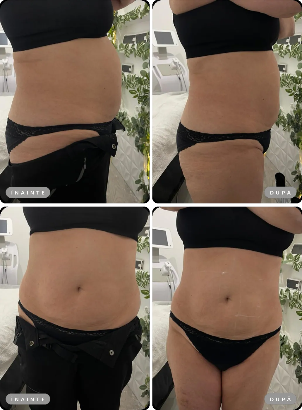 Rezultat real înainte și după, Liposonix abdomen, din profil