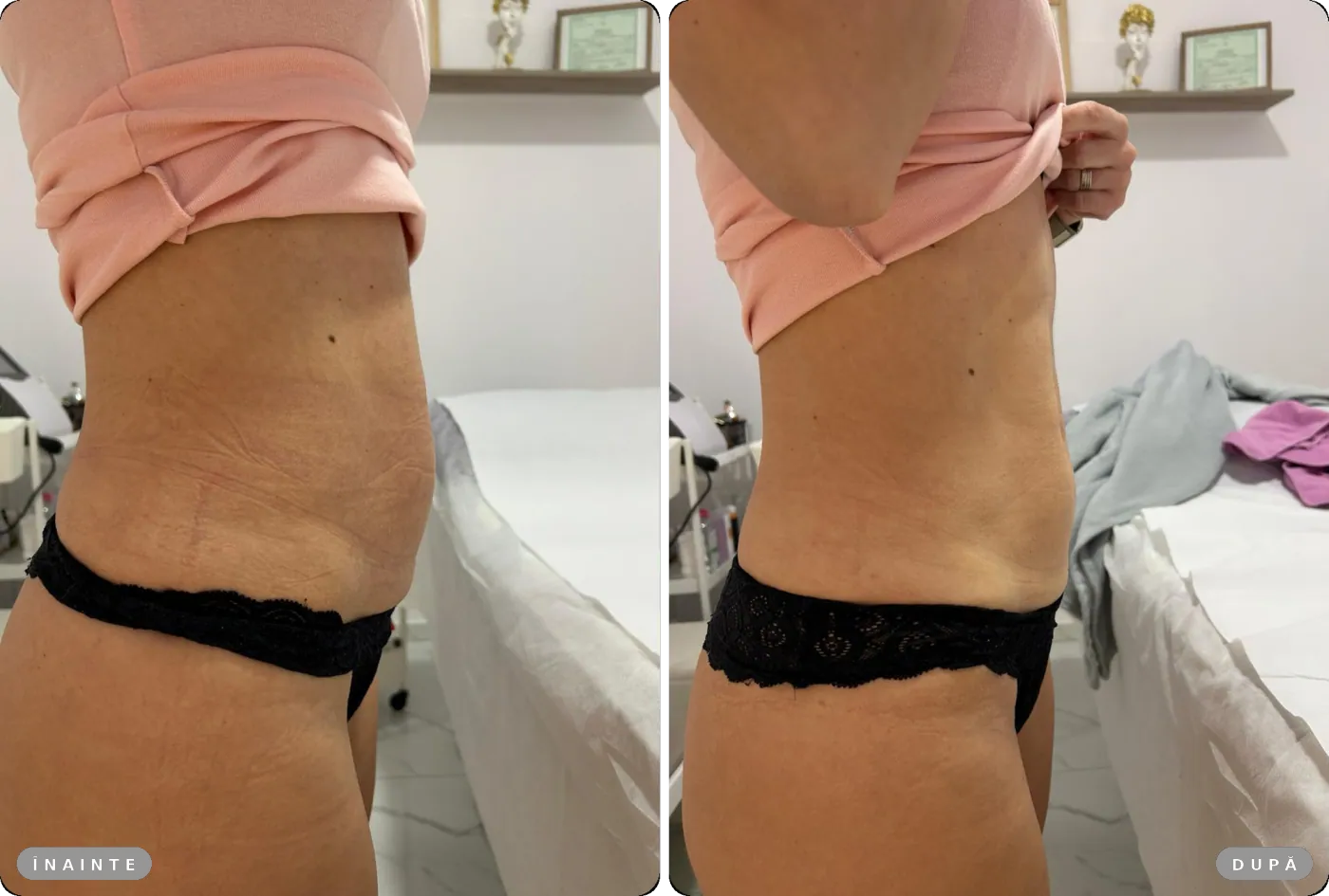 Rezultat real înainte și după, HIFU abdomen inferior