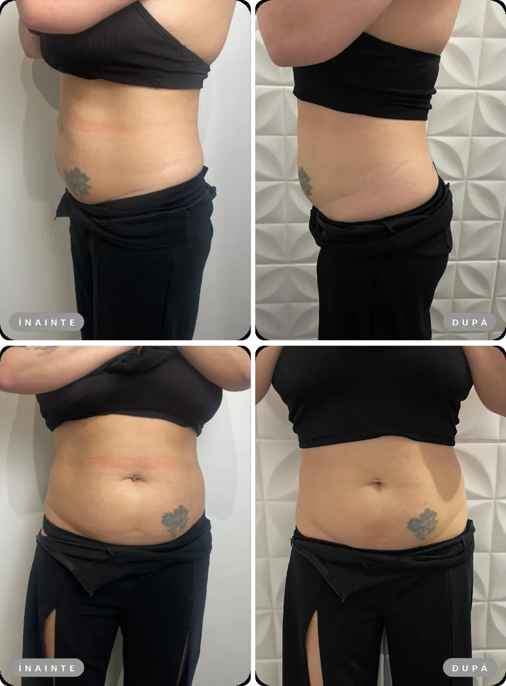 Rezultat real înainte și după, Liposonix și EMS