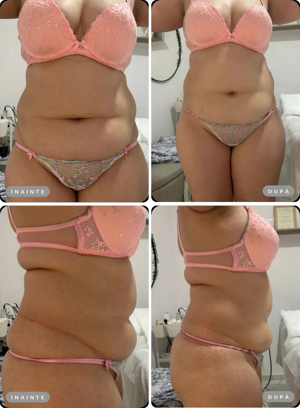 Rezultat real înainte și după, Liposonix abdomen total