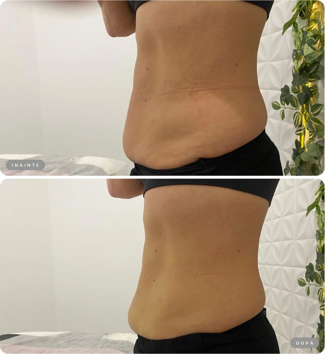 Rezultat real înainte și după, Liposonix abdomen