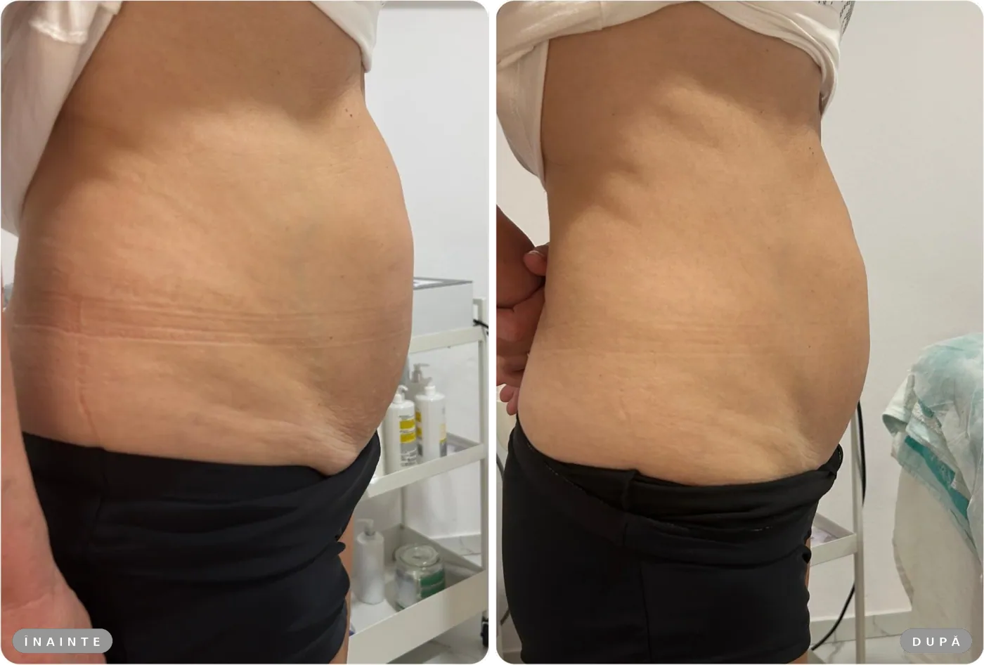Rezultat real înainte și după, HIFU abdomen