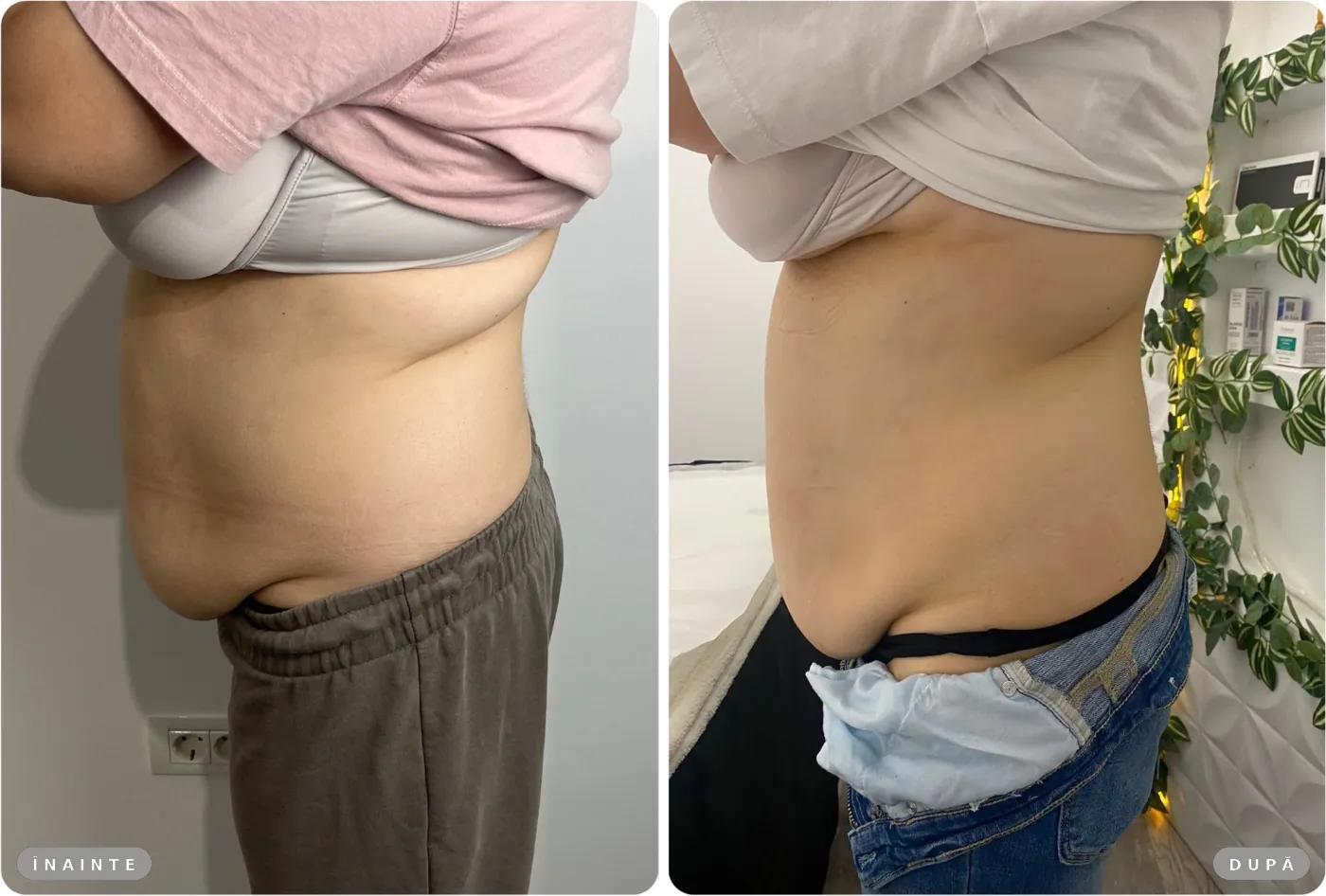 Rezultat real înainte și după, Liposonix + EMS