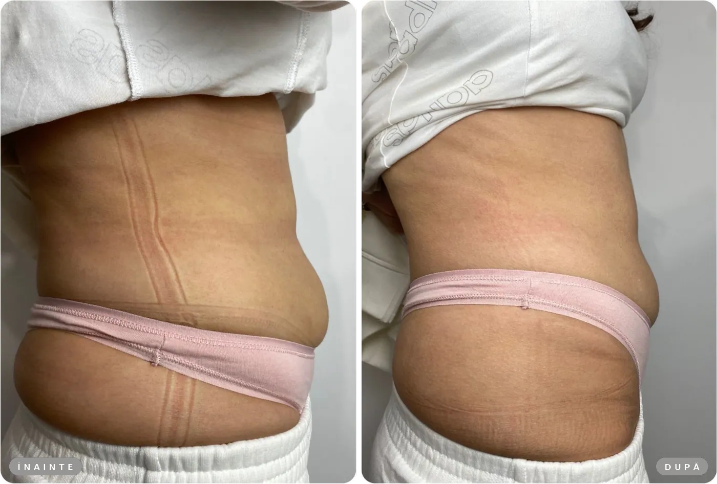 Rezultat real înainte și după, HIFU abdomen inferior