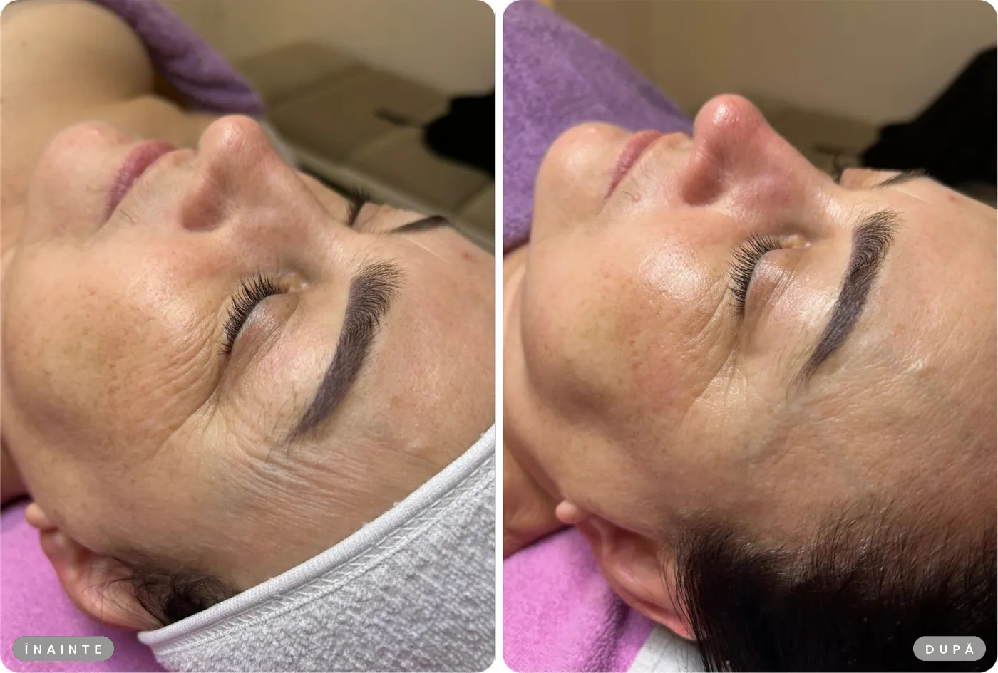 Rezultat real înainte și după, Tratament facial Restart