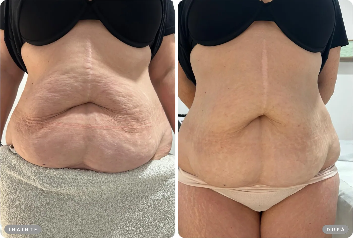 Rezultat real înainte și după, HIFU abdomen