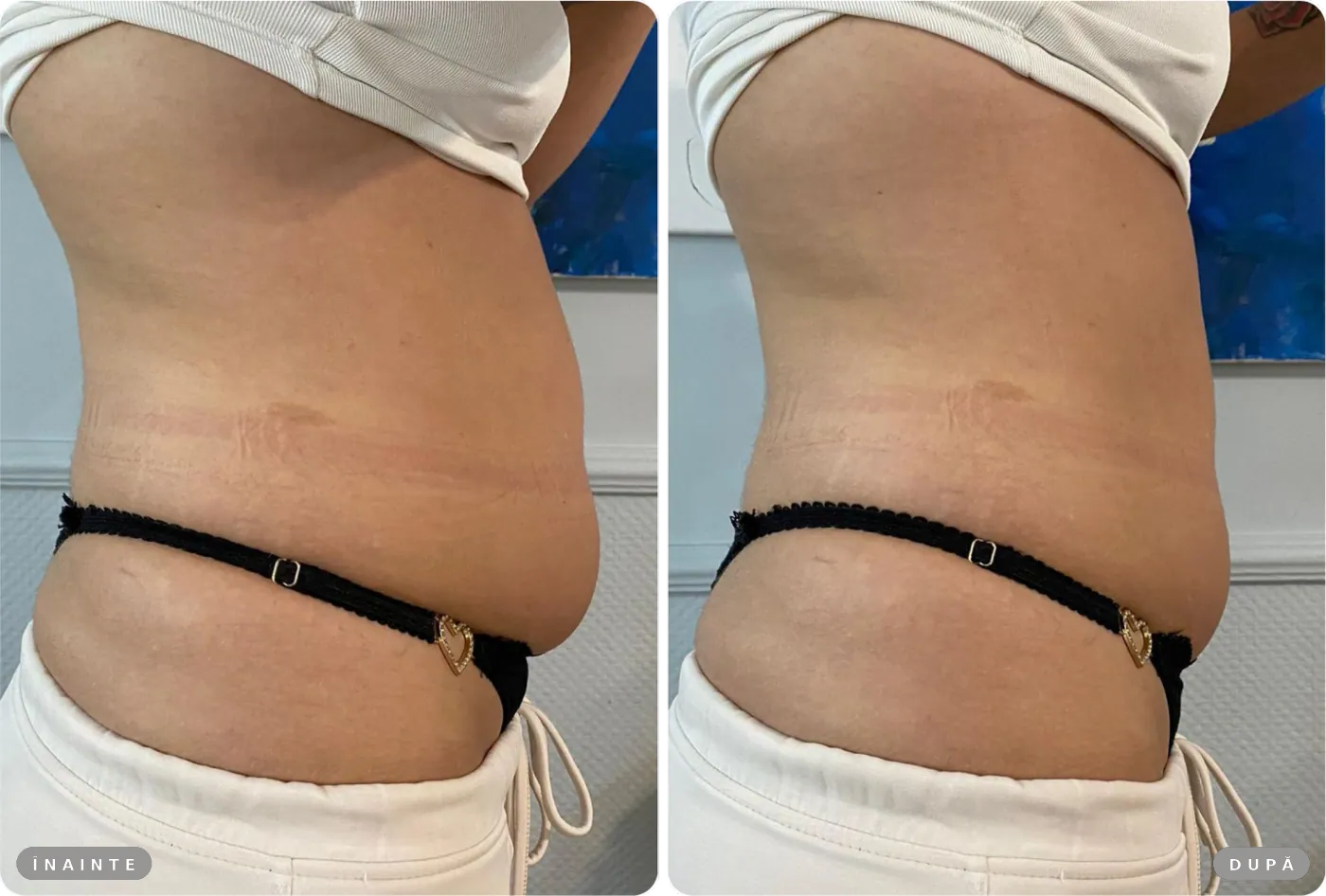Rezultat real înainte și după, HIFU abdomen