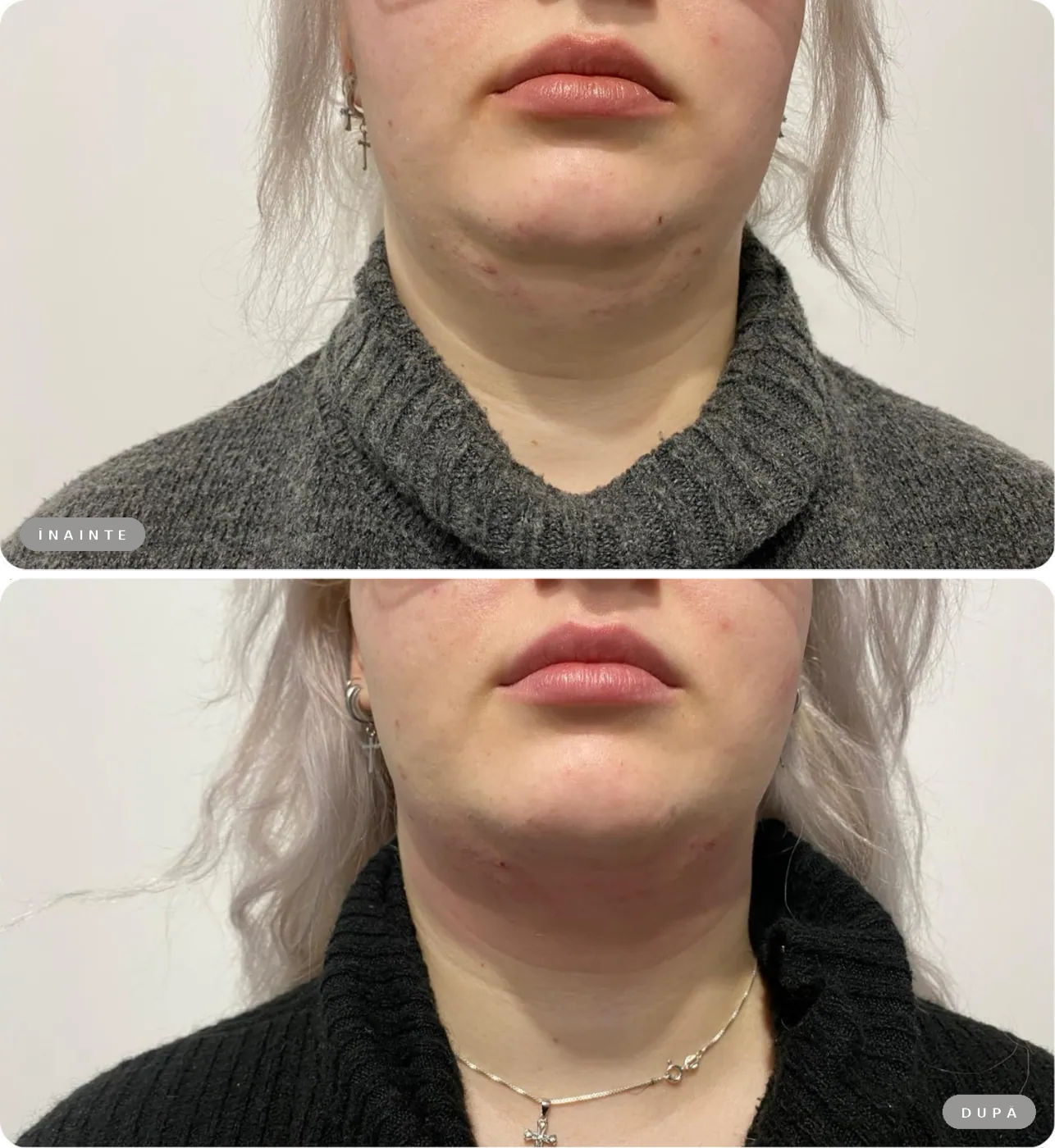 Rezultat real înainte și după, RF Sculpt