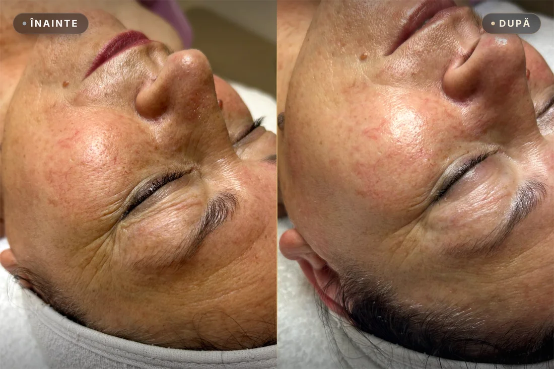 Rezultat real înainte și după — tratament facial Restart